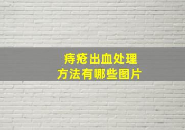 痔疮出血处理方法有哪些图片