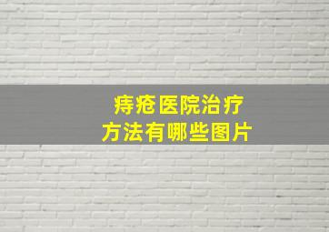 痔疮医院治疗方法有哪些图片